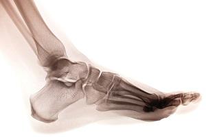 dump truck, Hartford personal injury lawyer